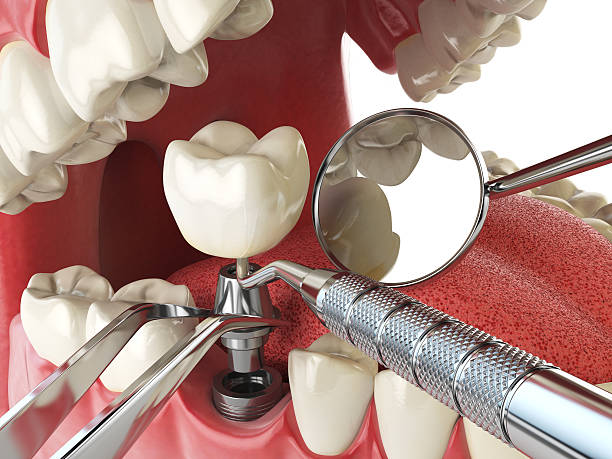 Best Broken or Chipped Tooth Repair in Mountain View Acres, CA